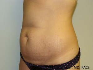 Tummy Tuck Before and After 32 | Grover Aesthetics
