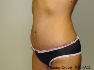 Tummy Tuck Before and After 32 | Sanjay Grover MD FACS