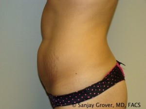 Tummy Tuck Before and After 32 | Sanjay Grover MD FACS