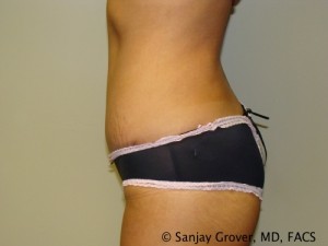 Tummy Tuck Before and After 32 | Sanjay Grover MD FACS