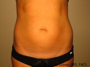 Tummy Tuck Before and After | Grover Aesthetics