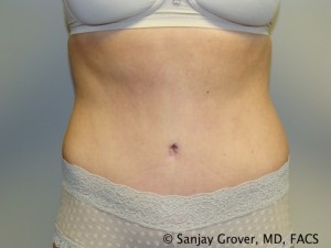 Tummy Tuck Before and After | Grover Aesthetics
