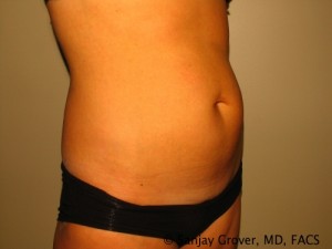 Tummy Tuck Before and After 34 | Sanjay Grover MD FACS