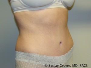 Tummy Tuck Before and After 34 | Grover Aesthetics