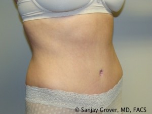 Tummy Tuck Before and After 34 | Sanjay Grover MD FACS