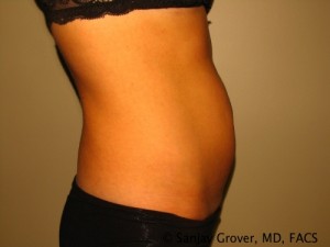 Tummy Tuck Before and After 34 | Sanjay Grover MD FACS