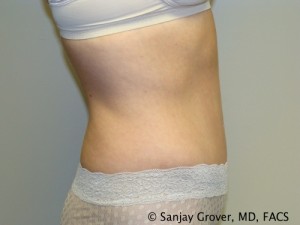 Tummy Tuck Before and After 34 | Sanjay Grover MD FACS