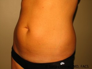 Tummy Tuck Before and After 34 | Sanjay Grover MD FACS