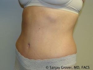 Tummy Tuck Before and After 34 | Sanjay Grover MD FACS