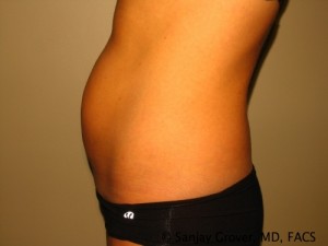 Tummy Tuck Before and After 34 | Sanjay Grover MD FACS