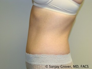 Tummy Tuck Before and After 34 | Sanjay Grover MD FACS