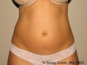 Tummy Tuck Before and After | Grover Aesthetics
