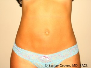 Tummy Tuck Before and After 35 | Sanjay Grover MD FACS