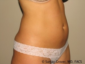 Tummy Tuck Before and After 35 | Sanjay Grover MD FACS