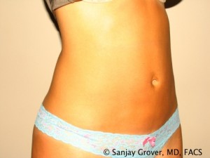 Tummy Tuck Before and After 35 | Sanjay Grover MD FACS