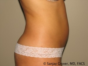 Tummy Tuck Before and After 35 | Sanjay Grover MD FACS