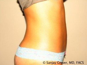 Tummy Tuck Before and After 35 | Sanjay Grover MD FACS