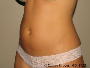 Tummy Tuck Before and After 35 | Sanjay Grover MD FACS