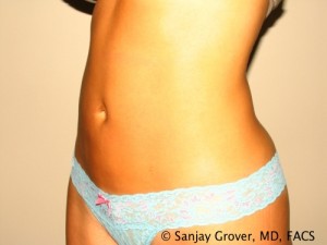 Tummy Tuck Before and After 35 | Sanjay Grover MD FACS