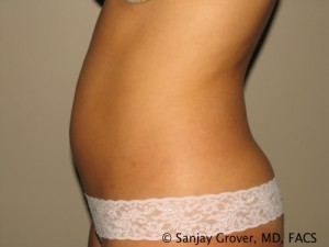 Tummy Tuck Before and After 35 | Sanjay Grover MD FACS