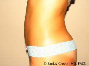 Tummy Tuck Before and After 35 | Grover Aesthetics