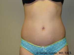 Tummy Tuck Before and After 04 | Sanjay Grover MD FACS