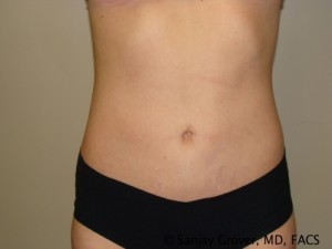 Tummy Tuck Before and After | Grover Aesthetics