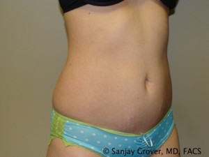 Tummy Tuck Before and After 36 | Sanjay Grover MD FACS