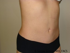 Tummy Tuck Before and After 36 | Sanjay Grover MD FACS