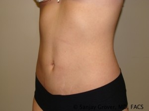 Tummy Tuck Before and After 36 | Sanjay Grover MD FACS