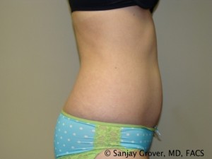 Tummy Tuck Before and After 36 | Sanjay Grover MD FACS