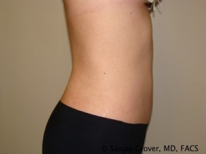 Tummy Tuck Before and After 36 | Sanjay Grover MD FACS