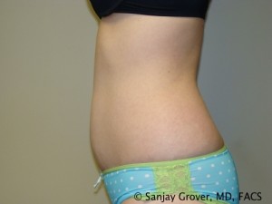 Tummy Tuck Before and After 36 | Sanjay Grover MD FACS