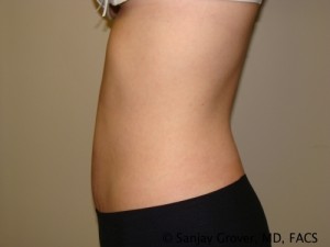 Tummy Tuck Before and After 36 | Sanjay Grover MD FACS