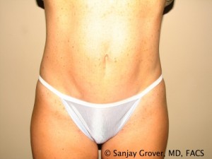 Tummy Tuck Before and After 37 | Sanjay Grover MD FACS