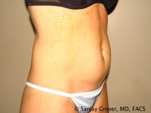 Tummy Tuck Before and After 37 | Sanjay Grover MD FACS