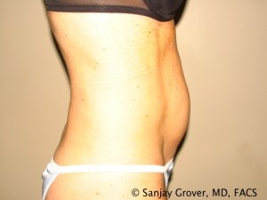 Tummy Tuck Before and After 37 | Grover Aesthetics