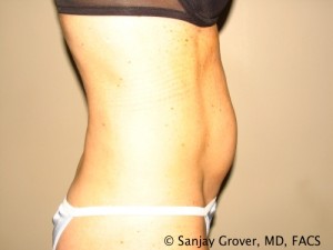 Tummy Tuck Before and After 37 | Sanjay Grover MD FACS