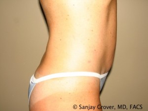 Tummy Tuck Before and After 37 | Grover Aesthetics