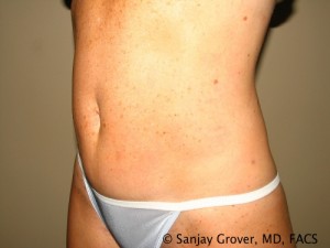 Tummy Tuck Before and After 37 | Sanjay Grover MD FACS