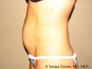 Tummy Tuck Before and After 37 | Grover Aesthetics
