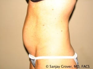 Tummy Tuck Before and After 37 | Sanjay Grover MD FACS