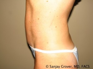 Tummy Tuck Before and After 37 | Sanjay Grover MD FACS