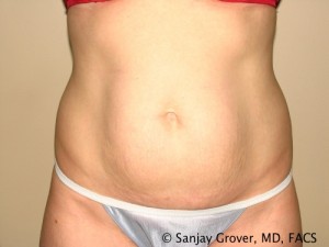 Tummy Tuck Before and After | Grover Aesthetics
