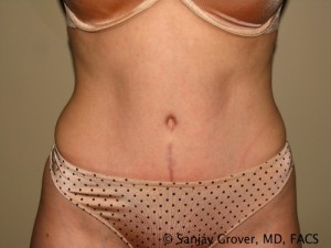 Tummy Tuck Before and After 38 | Sanjay Grover MD FACS