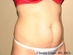 Tummy Tuck Before and After 38 | Sanjay Grover MD FACS