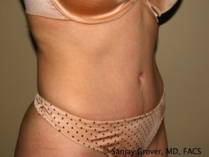 Tummy Tuck Before and After 38 | Sanjay Grover MD FACS