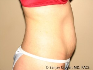 Tummy Tuck Before and After 38 | Sanjay Grover MD FACS