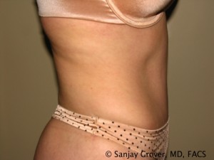 Tummy Tuck Before and After 38 | Sanjay Grover MD FACS