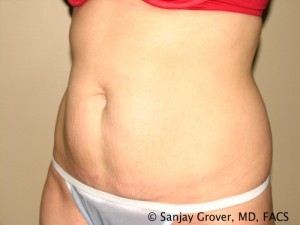 Tummy Tuck Before and After 38 | Sanjay Grover MD FACS